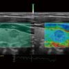 Elastography