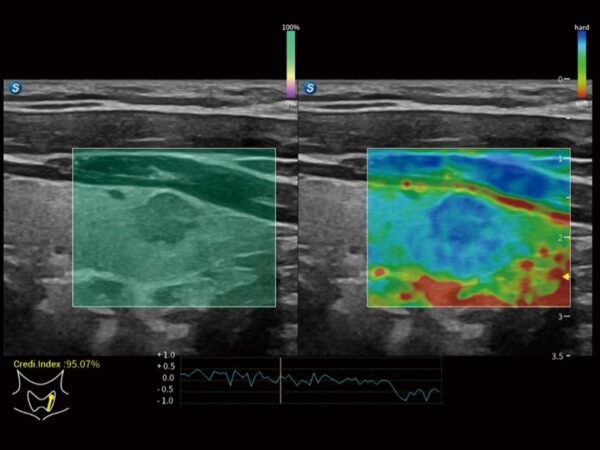 Elastography